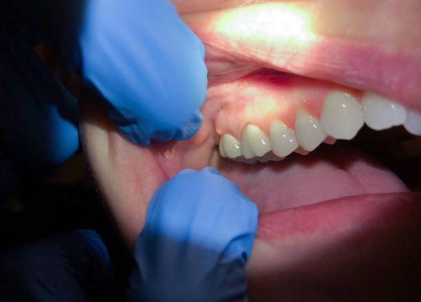 Best Chipped Tooth Repair Near Me  in Beaumont, CA